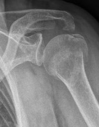 Proximaler Oberarmbruch3 Proximaler Oberarmbruch3