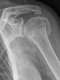 Proximaler Oberarmbruch4 Proximaler Oberarmbruch4