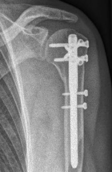 Proximaler Oberarmbruch8 Proximaler Oberarmbruch8